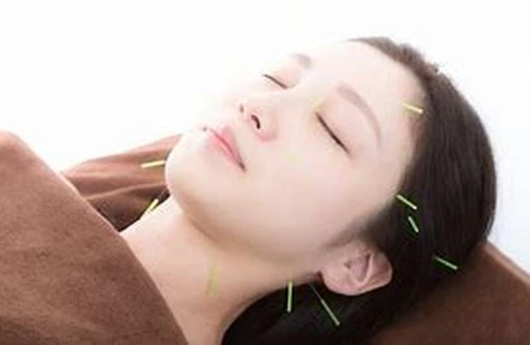 美と健康の新しい形！美容鍼で魅力を引き出し、リフトアップを実現！