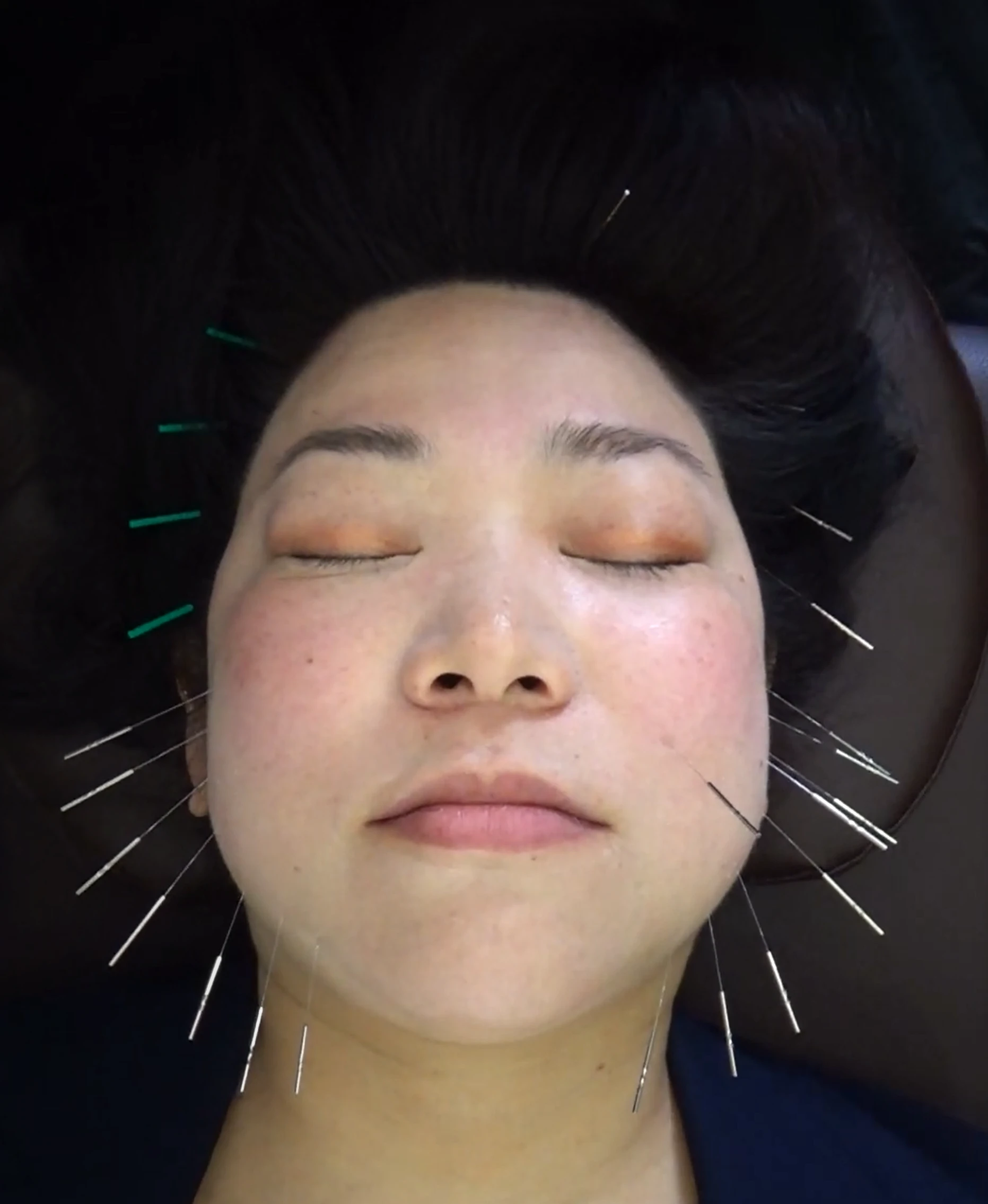 小顔美人になれる施術