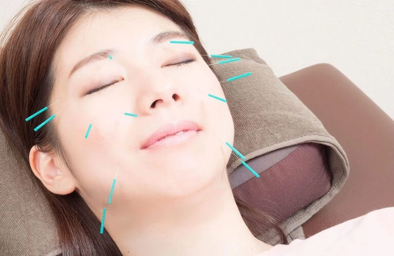 手軽に美容鍼で若々しさを手に入れよう！