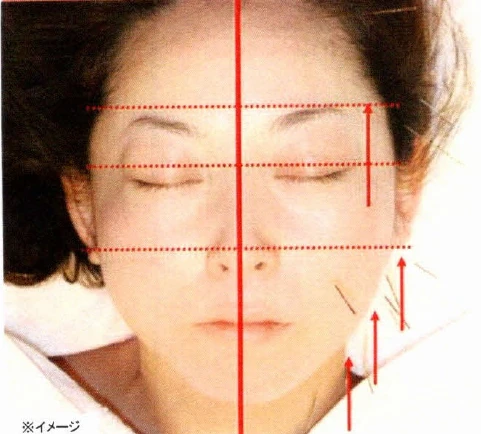 美容鍼の効果とは？