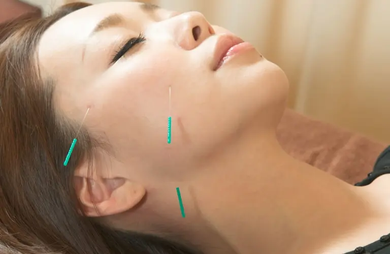 美容鍼で理想のリフトアップを実現！