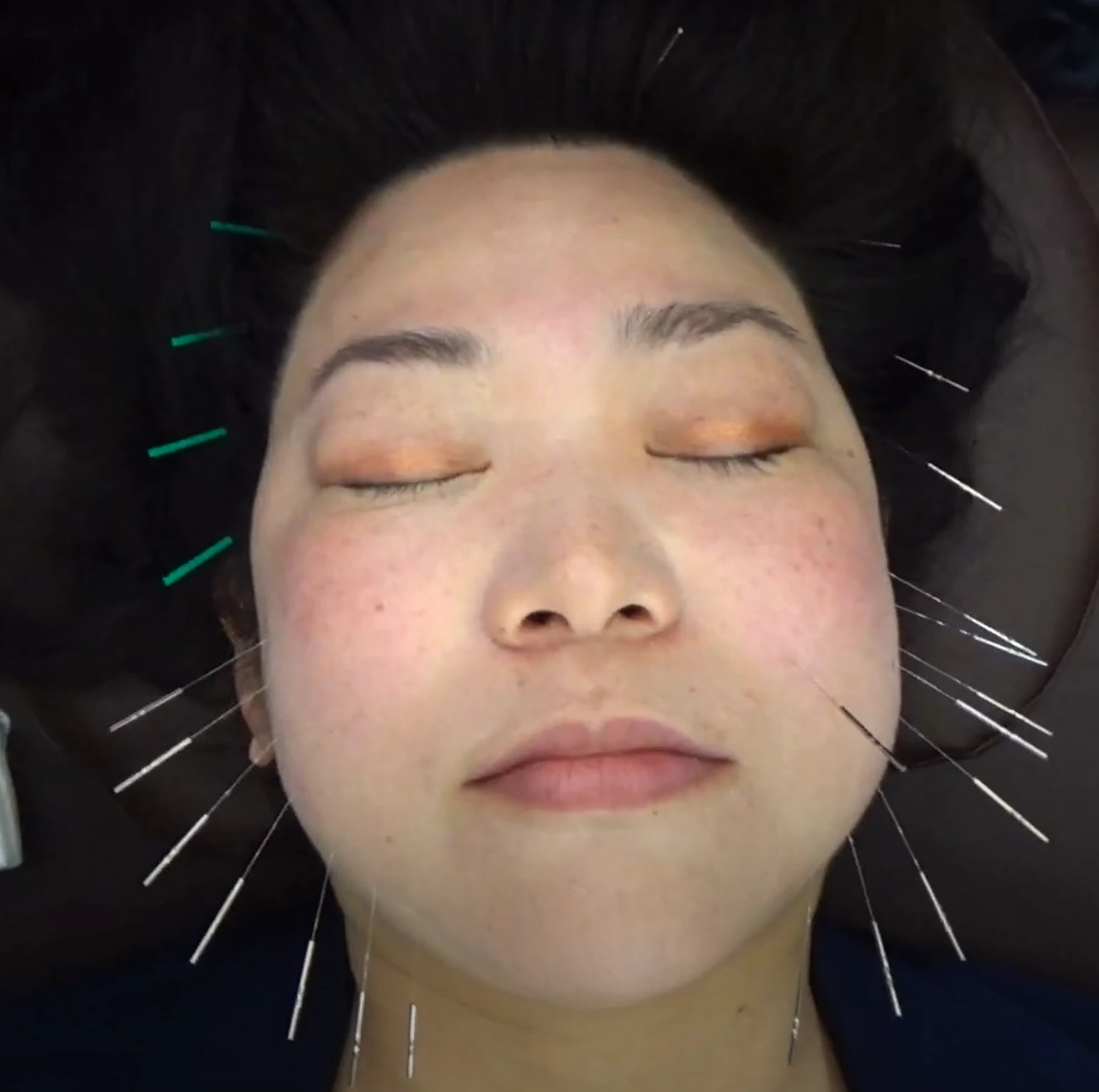 2. 美容鍼の効果