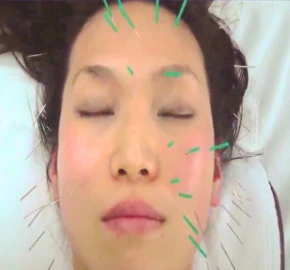 美容鍼とは？その魅力と効果